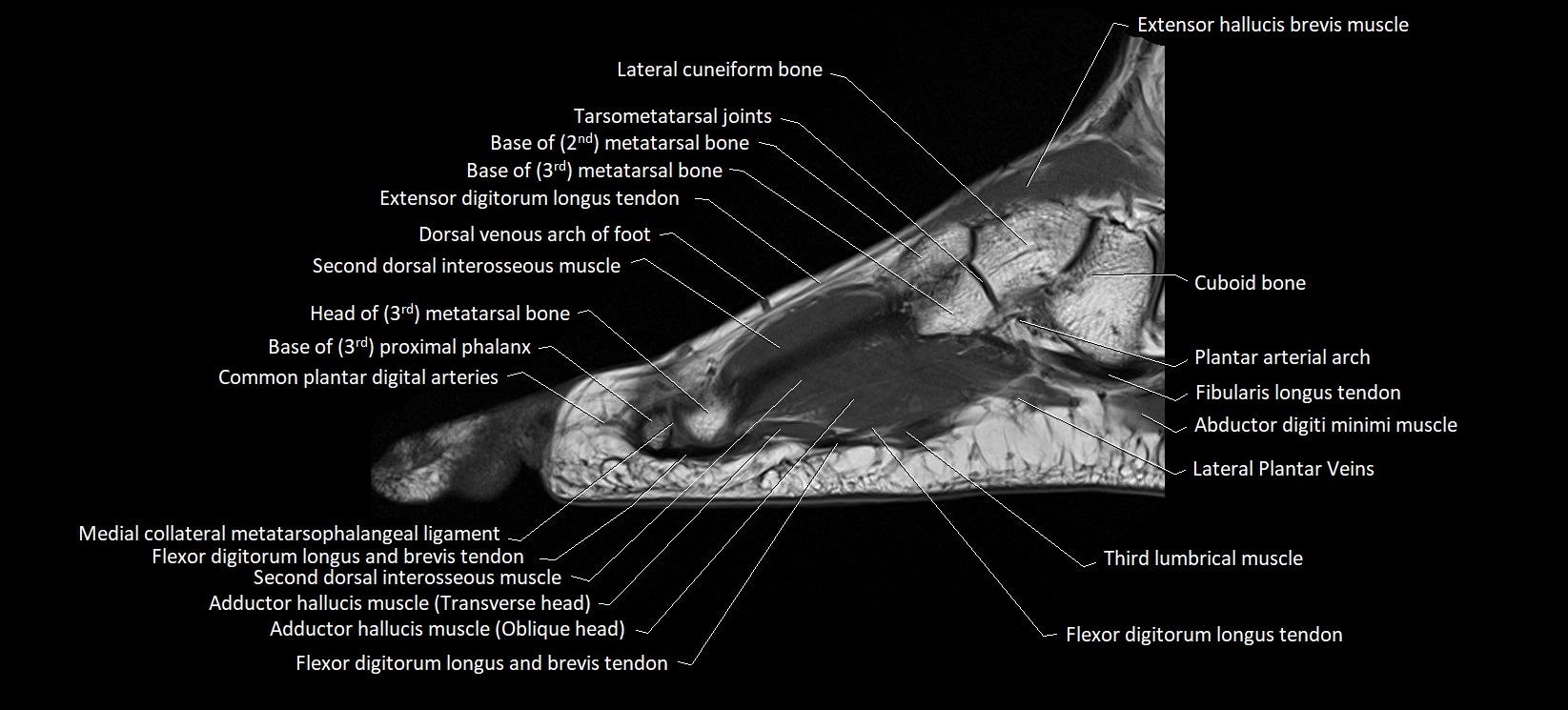 MRI foot sagittal labelled cross sectional anatomy image  15.webp